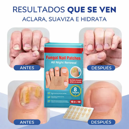PARCHE DE HONGO - 2x1 ( 32 Parches)